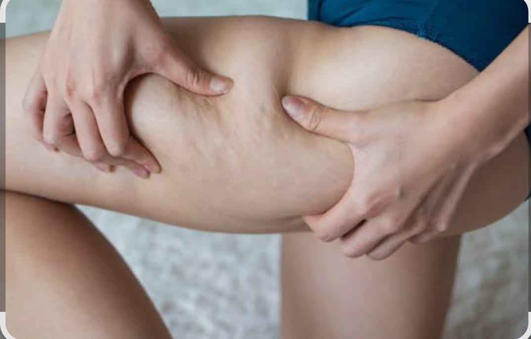 Tratamento para Celulite