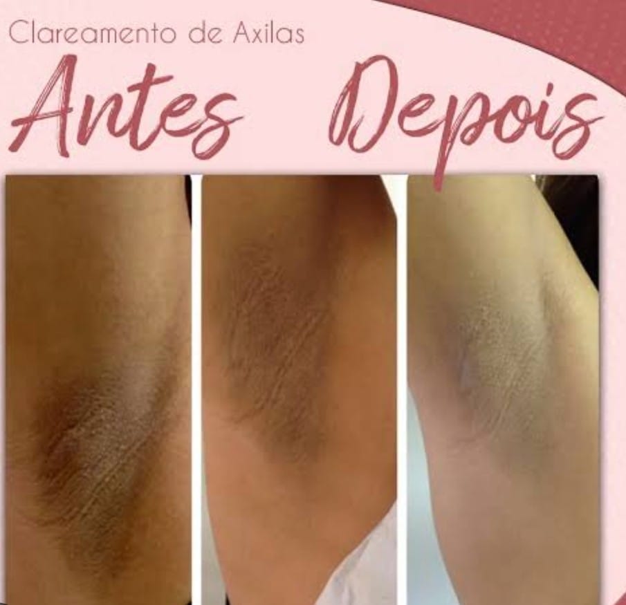Clareamento de Axilas