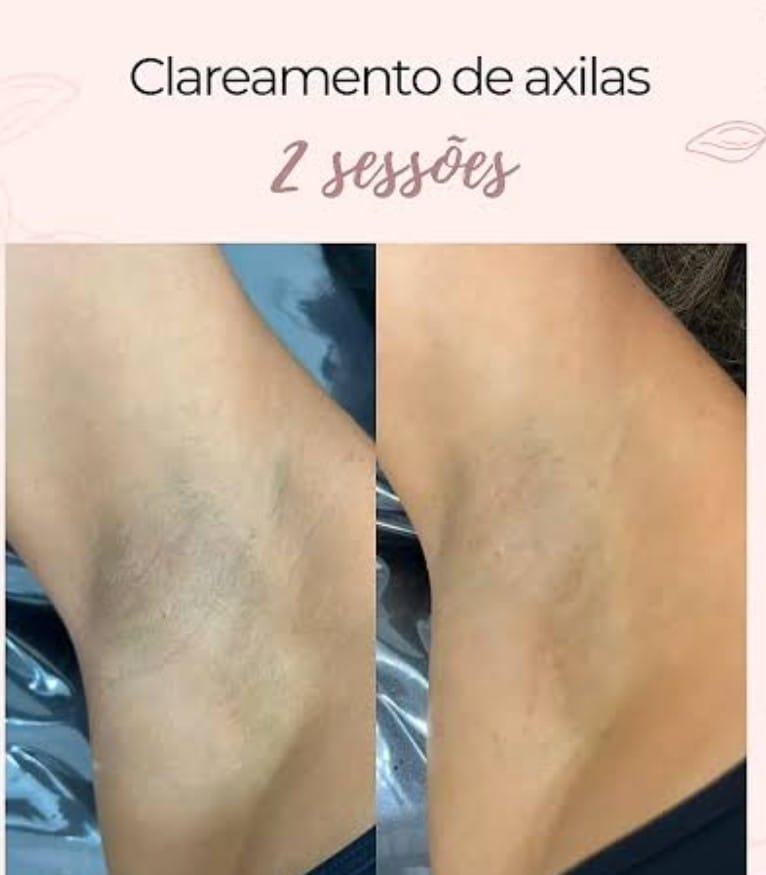 Clareamento de Axilas