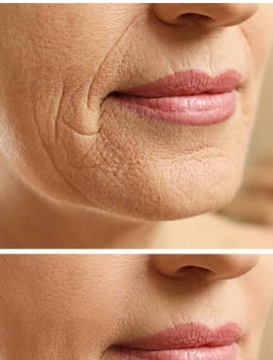 Tratamento para Flacidez Facial