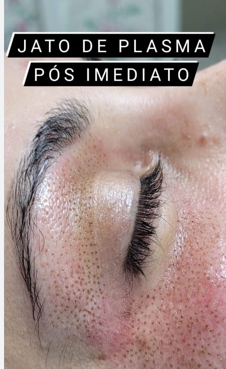 Jato de Plasma